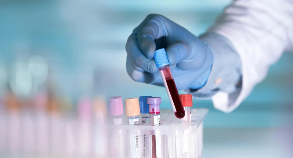 Um simples exame de sangue pode detectar Alzheimer anos antes dos sintomas.