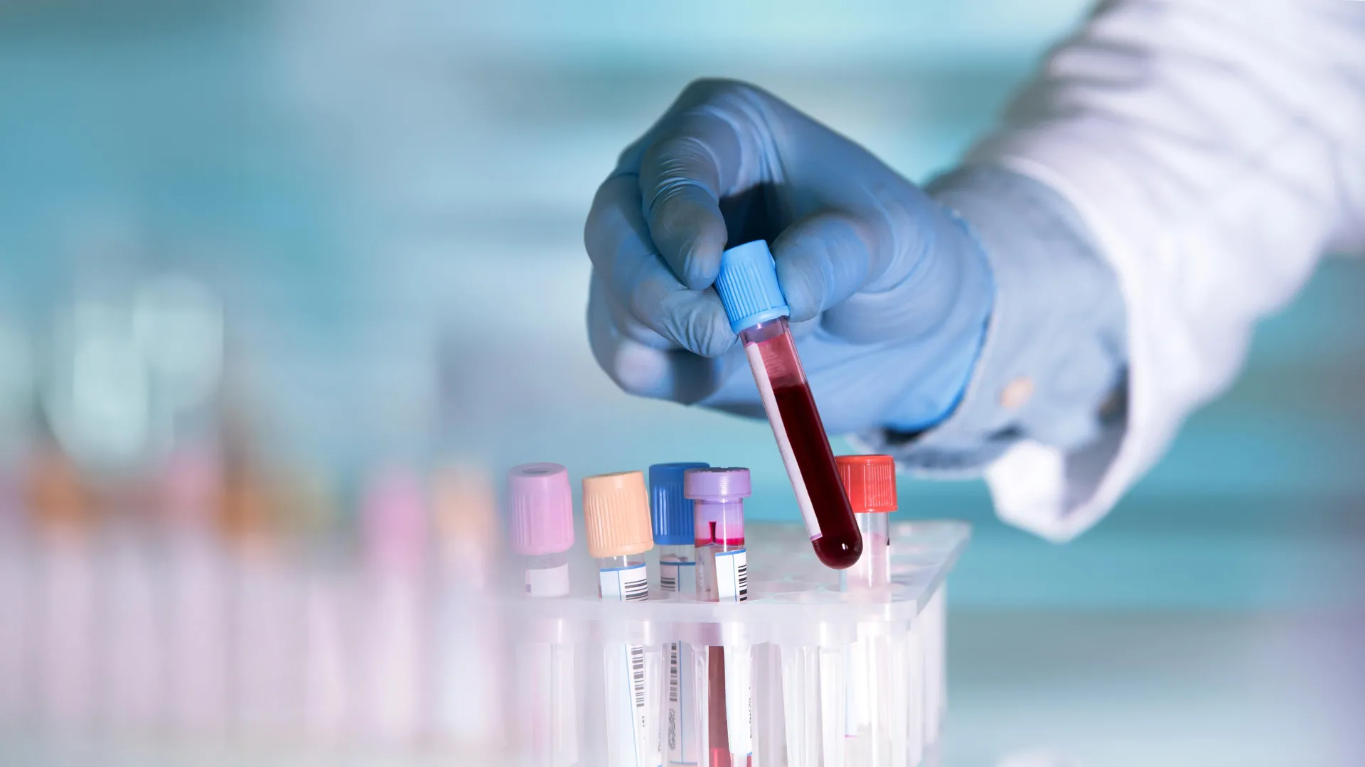 Um simples exame de sangue pode detectar Alzheimer anos antes dos sintomas.