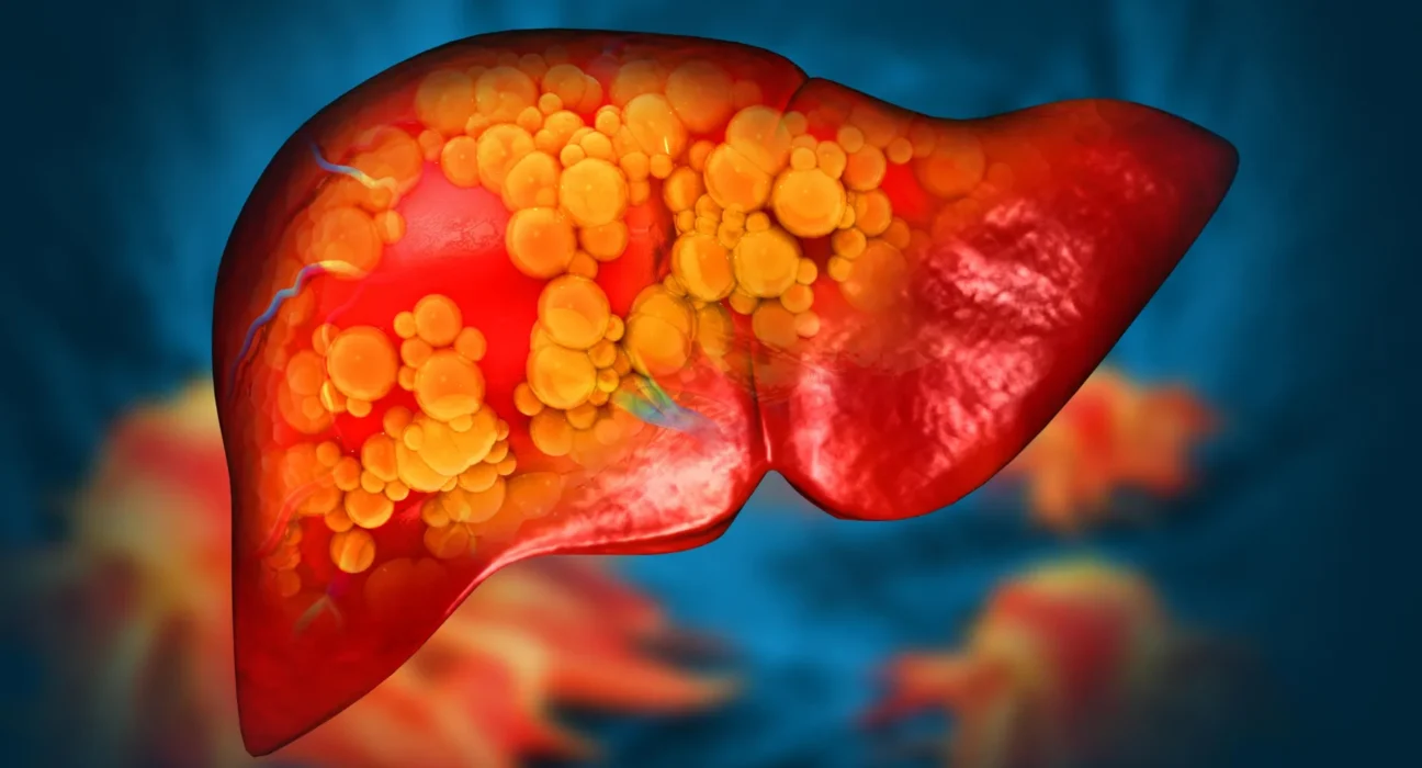 Novo medicamento pode ser o primeiro a combater a doença hepática gordurosa fatal