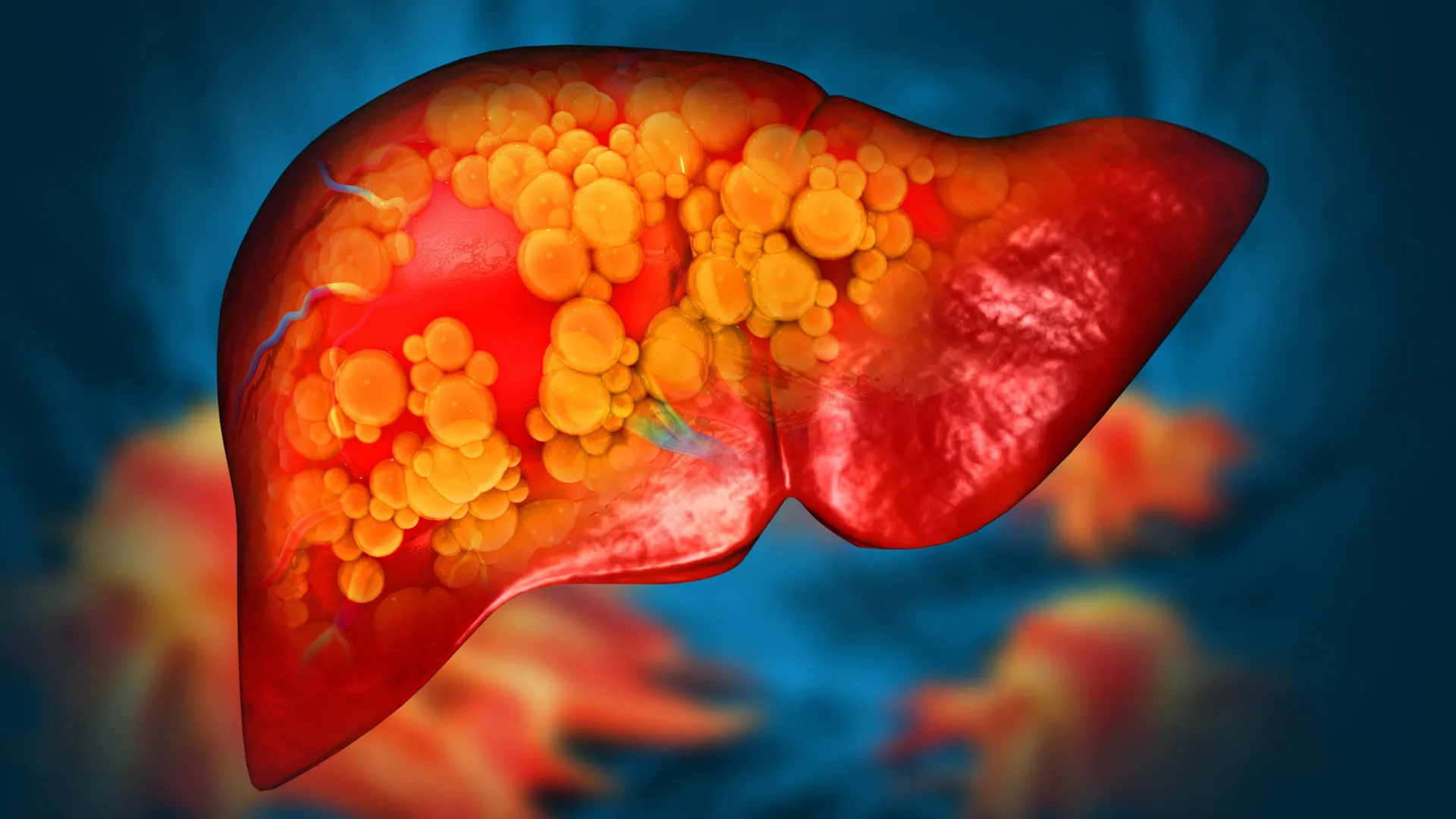Novo medicamento pode ser o primeiro a combater a doença hepática gordurosa fatal