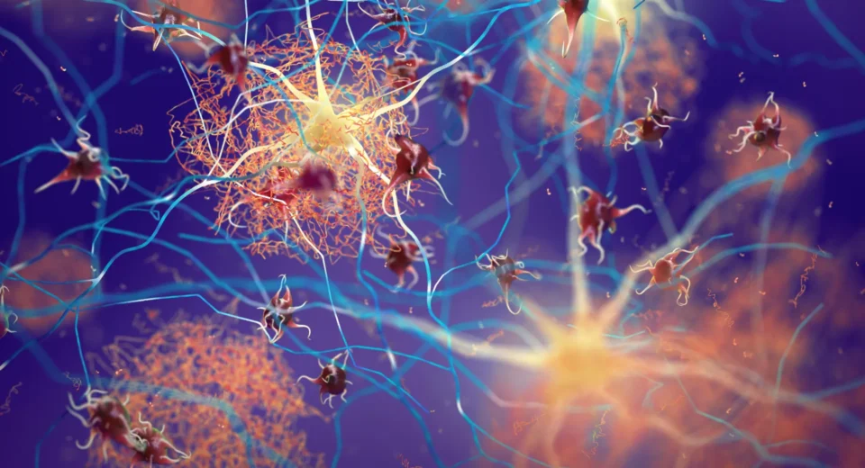 Sinais Ocultos de Alzheimer em Pacientes com Parkinson Sem Demência