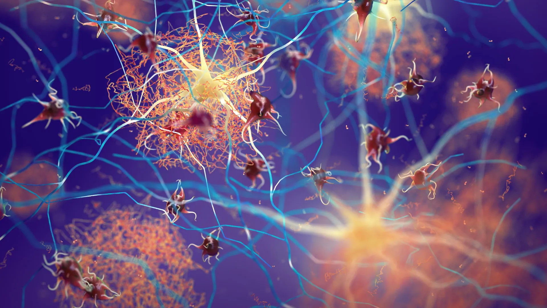 Sinais Ocultos de Alzheimer em Pacientes com Parkinson Sem Demência