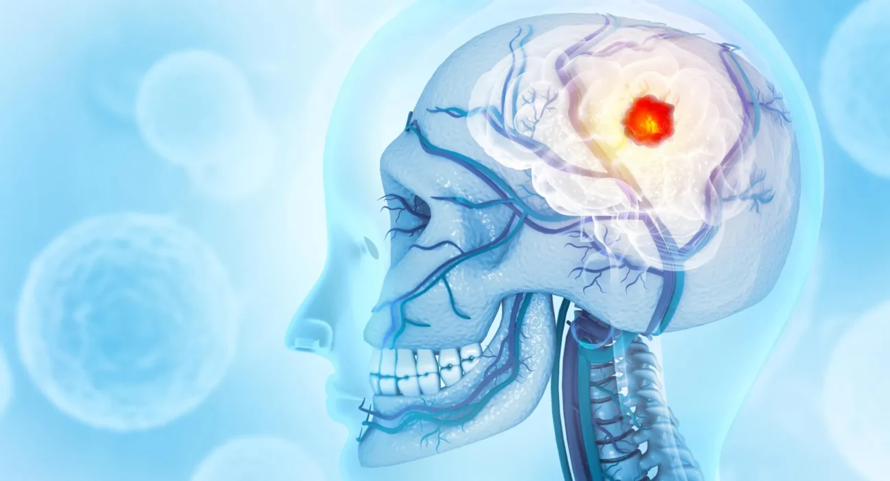 Câncer cerebral que consome o crânio surpreende cientistas