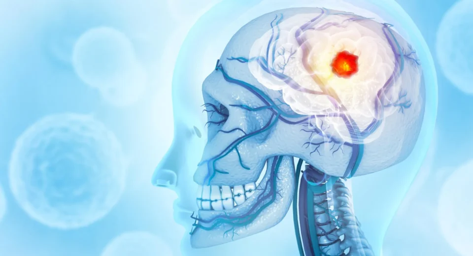 Câncer cerebral que consome o crânio surpreende cientistas