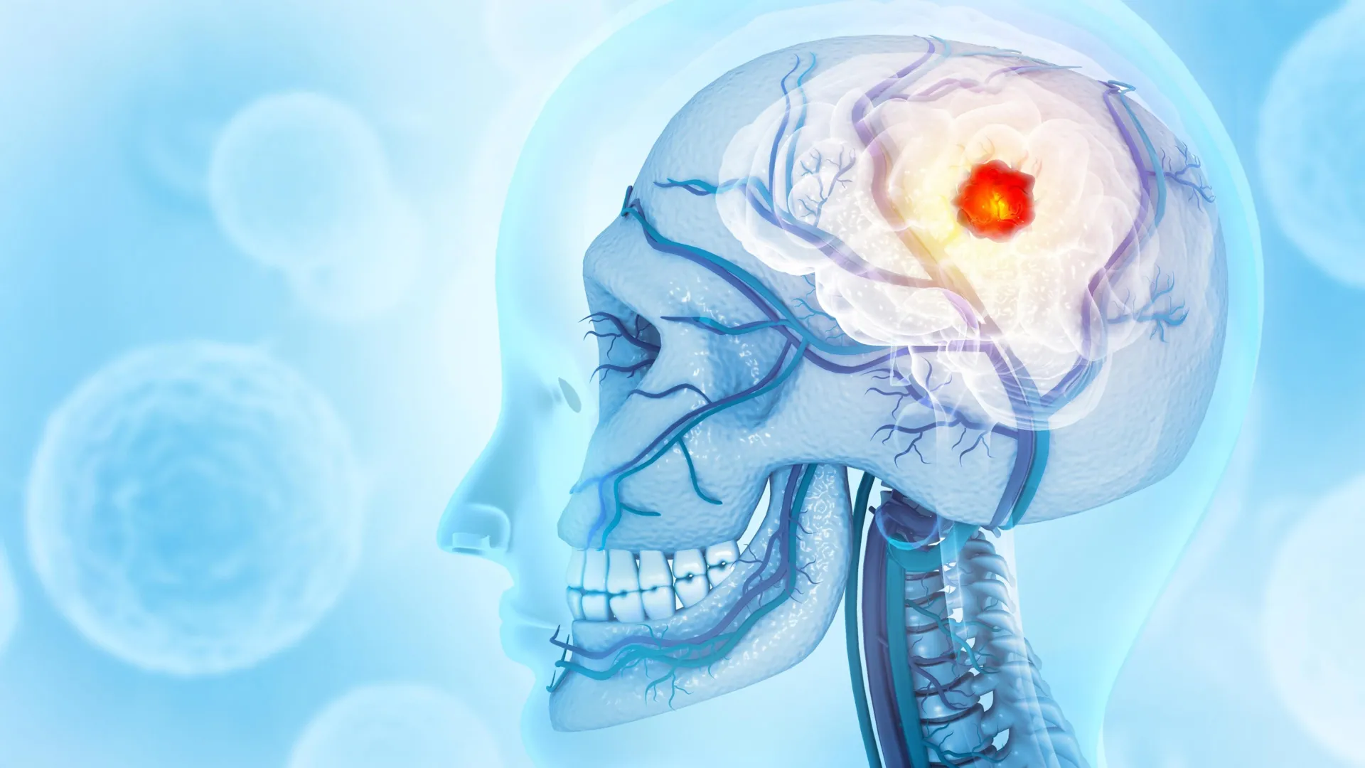 Câncer cerebral que consome o crânio surpreende cientistas