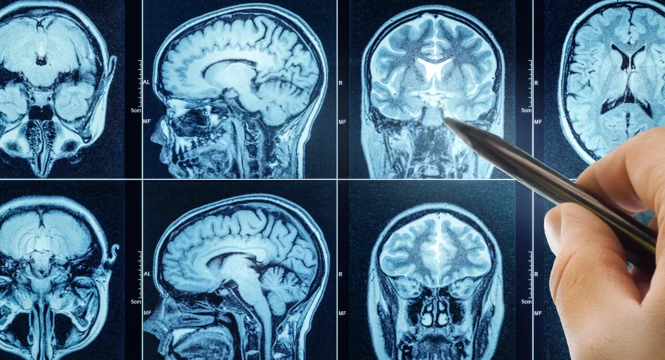 Sono ruim acelera o envelhecimento cerebral e pode aumentar o risco de demência.