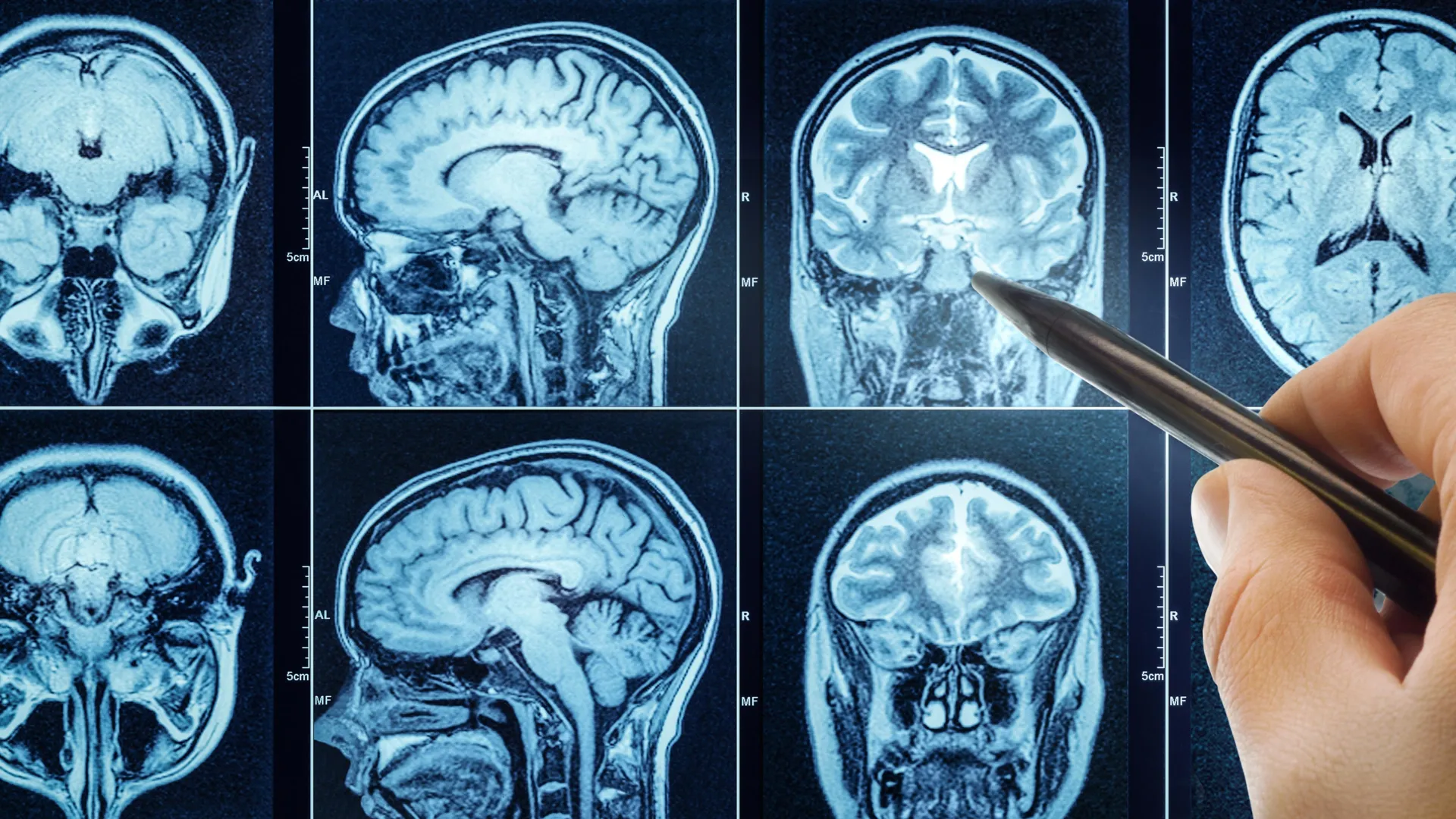 Sono ruim acelera o envelhecimento cerebral e pode aumentar o risco de demência.