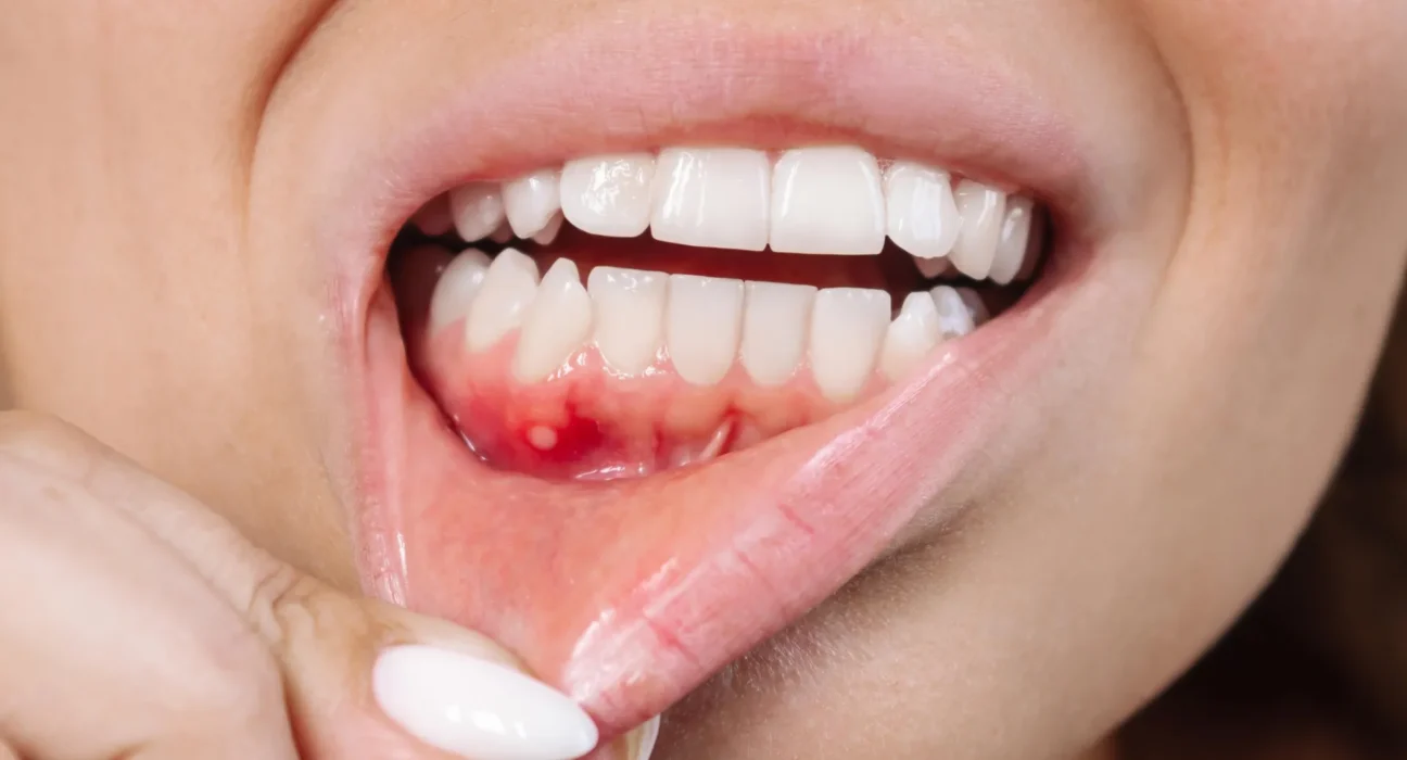 Um composto vegetal pode ser a arma secreta contra a doença gengival