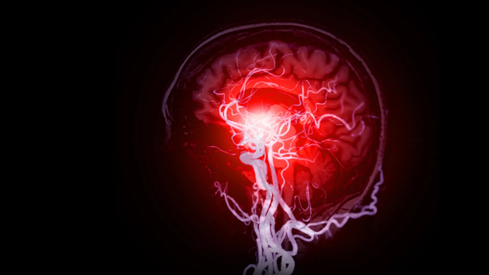 Cientistas Descobrem Danos Cerebrais Ocultos por Trás da Demência