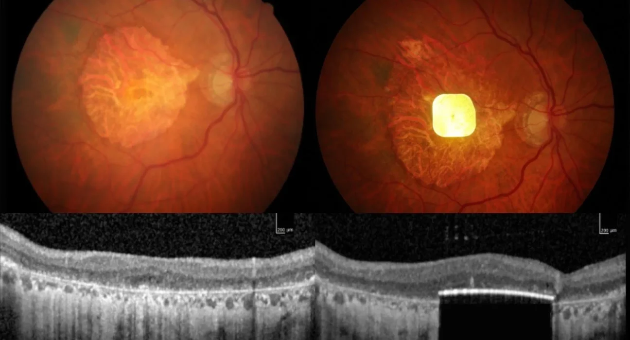 Implante ocular pequeno e alimentado por IA ajuda pessoas cegas a enxergar novamente