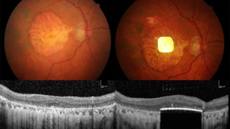 Implante ocular pequeno e alimentado por IA ajuda pessoas cegas a enxergar novamente