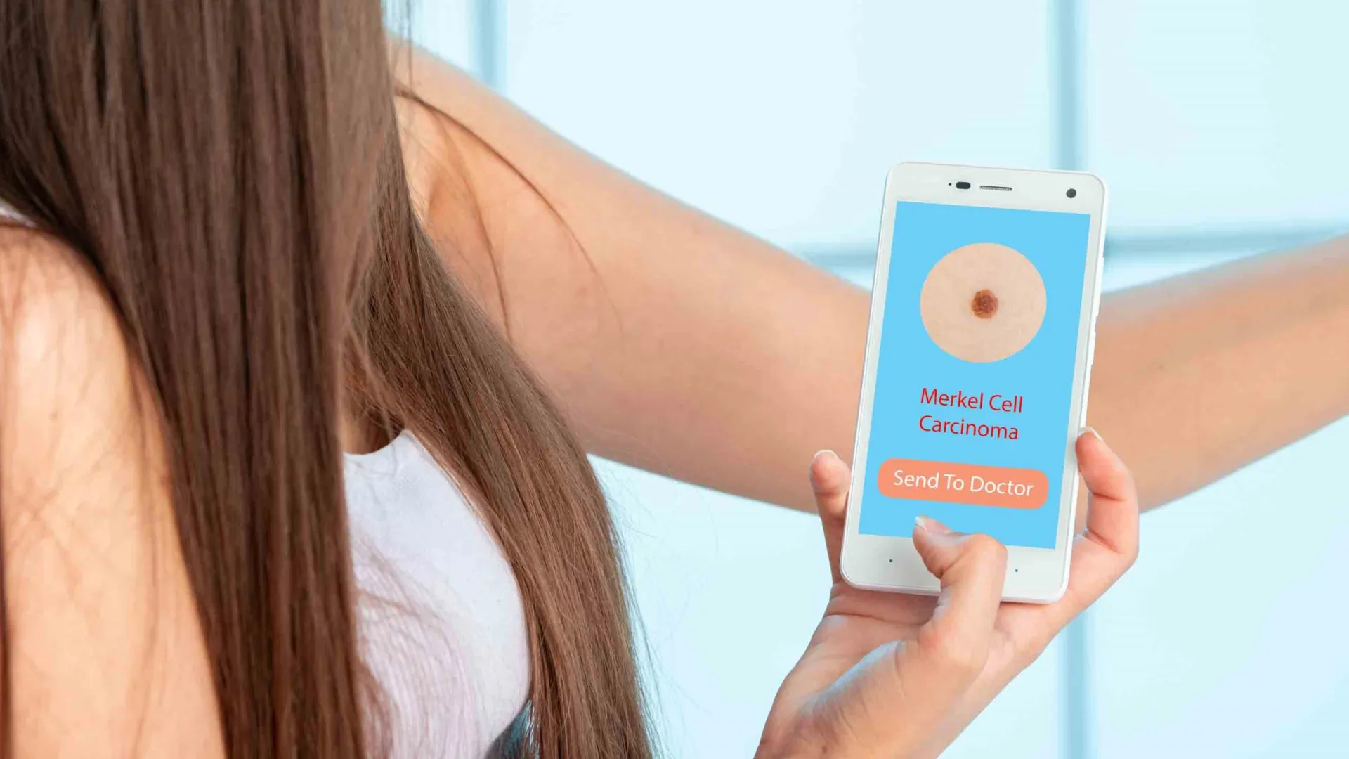 Cientistas descobrem medicamento imunológico que pode impedir a disseminação mortal do câncer de pele