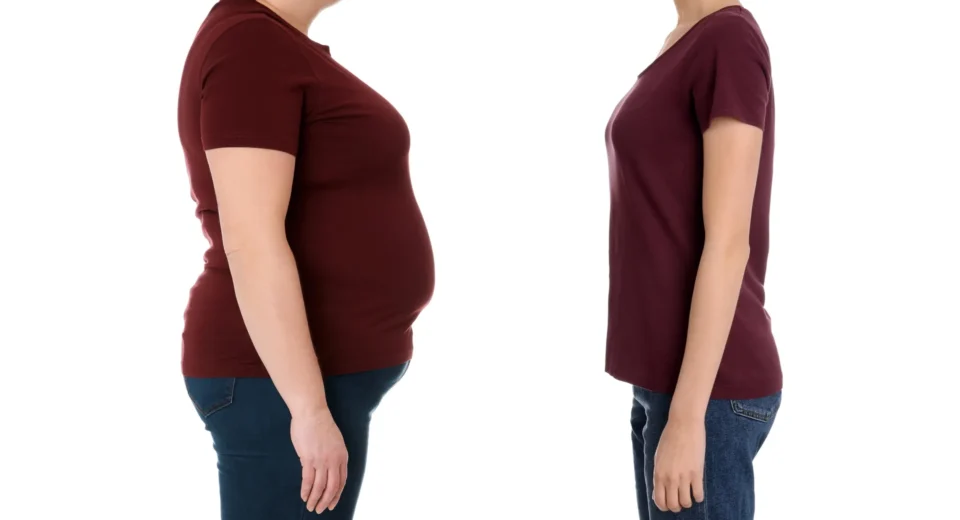 Cirurgia supera Ozempic para saúde a longo prazo, conclui Cleveland Clinic