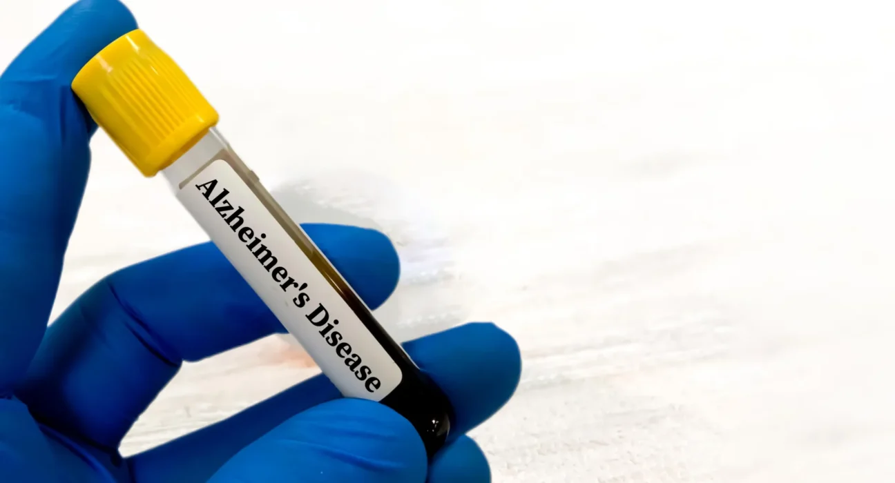 Testes sanguíneos para Alzheimer podem ser enganosos para pessoas com problemas renais