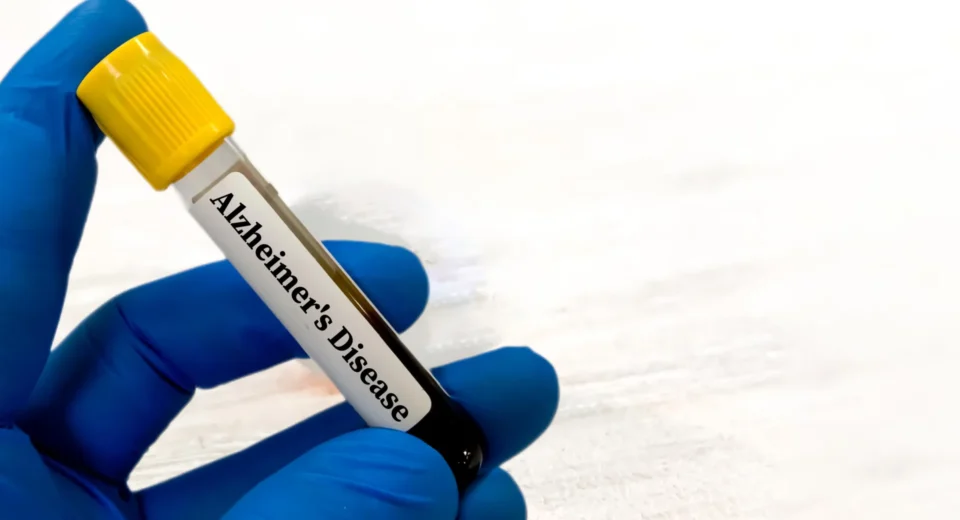 Testes sanguíneos para Alzheimer podem ser enganosos para pessoas com problemas renais