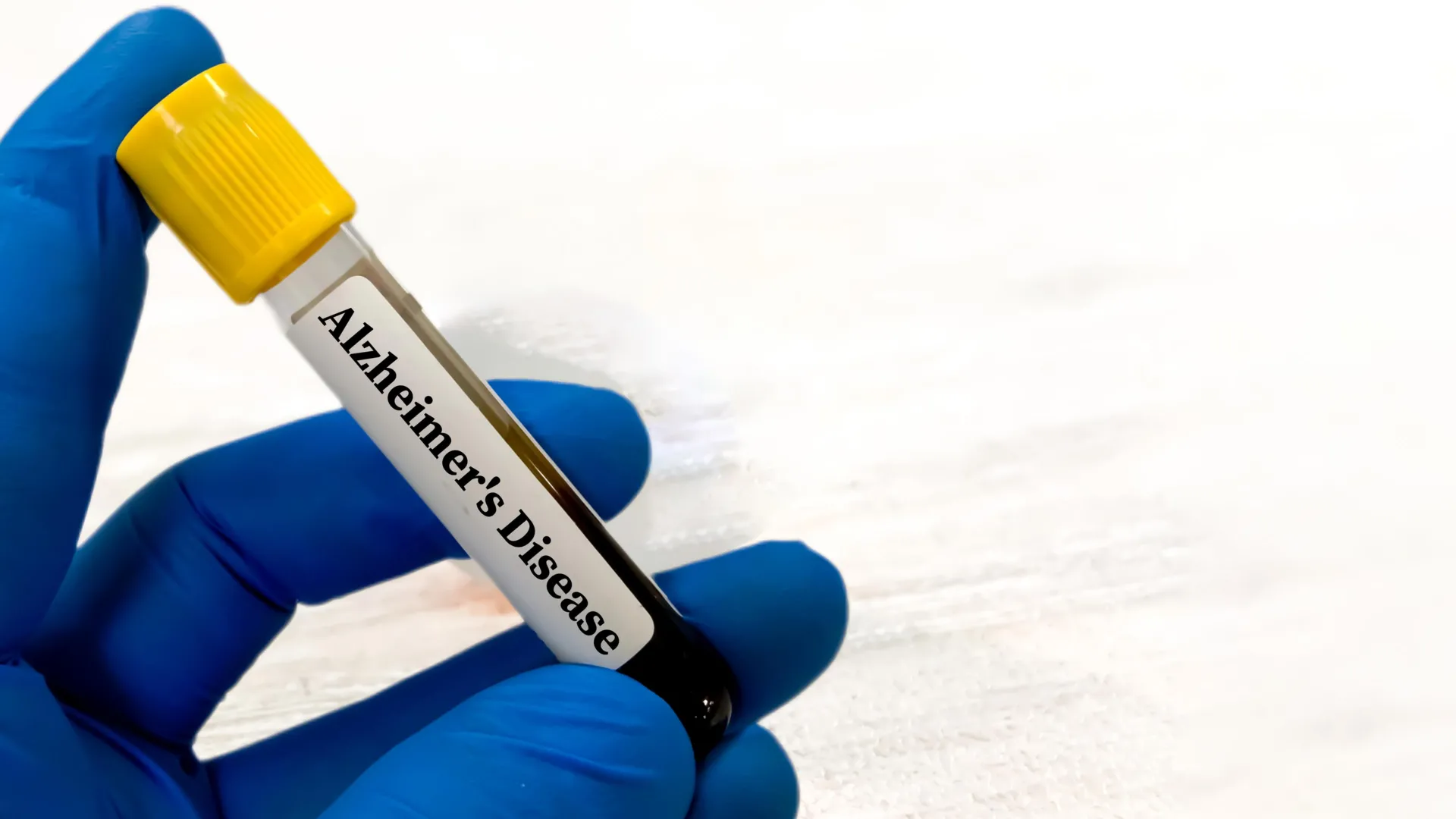 Testes sanguíneos para Alzheimer podem ser enganosos para pessoas com problemas renais