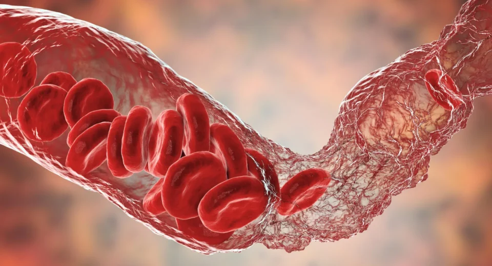 A Long COVID pode ser alimentada por inflamação e pequenos coágulos