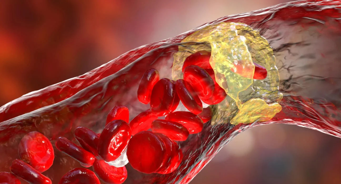 Medicamento potente para colesterol reduz risco de ataque cardíaco em 31%