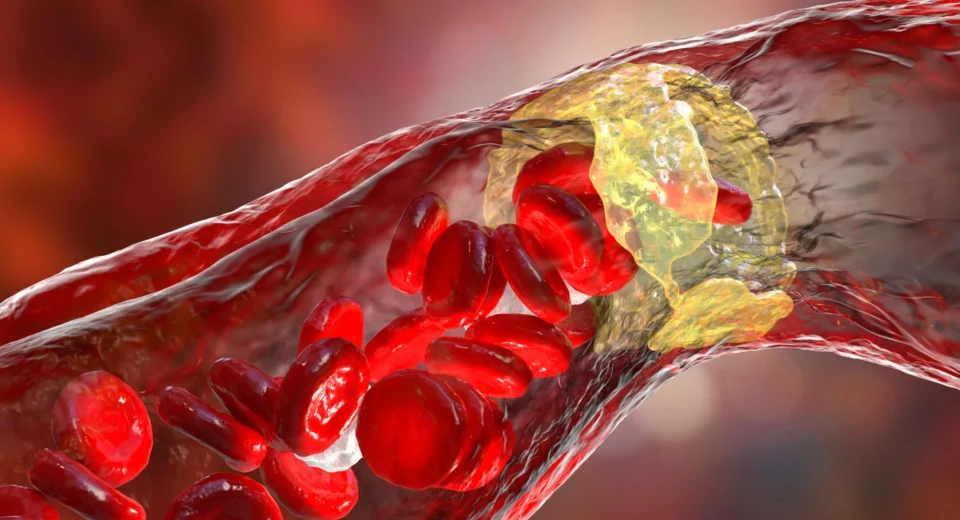 Medicamento potente para colesterol reduz risco de ataque cardíaco em 31%
