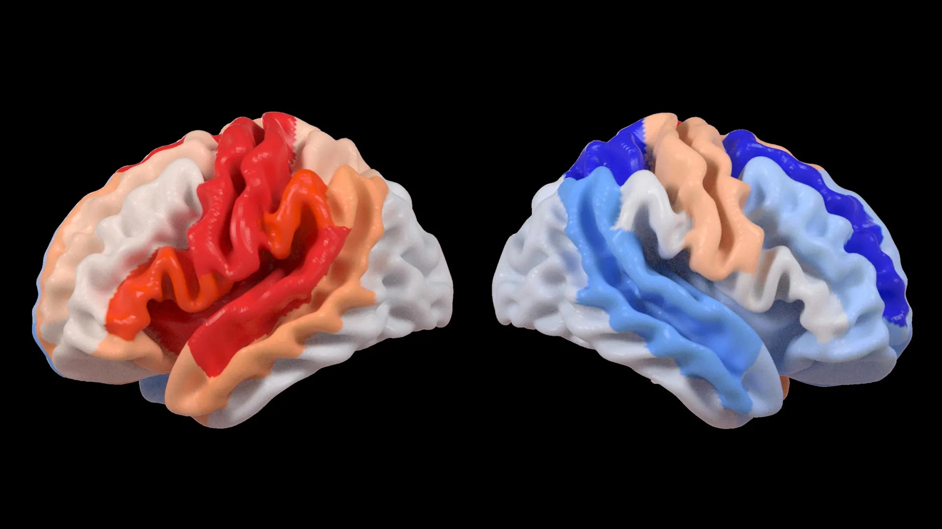 Um AVC provoca uma mudança cerebral oculta que parece rejuvenescimento