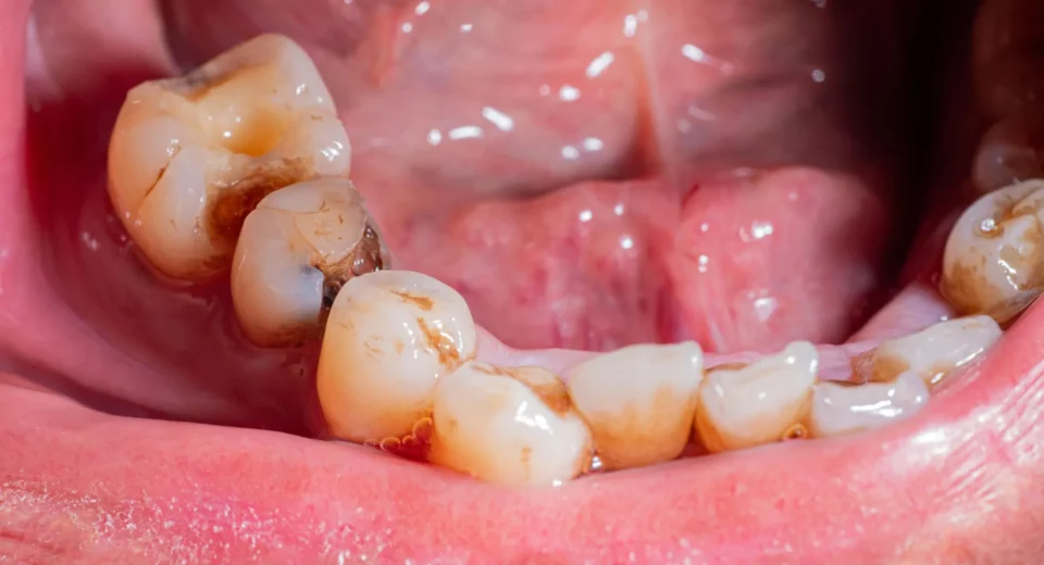 Saliva artificial feita de proteína de cana-de